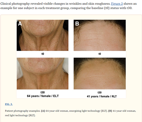 A Controlled Trial to Determine the Efficacy of Red and Near-Infrared Light Treatment in Patient Satisfaction, Reduction of Fine Lines, Wrinkles, Skin Roughness, and Intradermal Collagen Density Increase